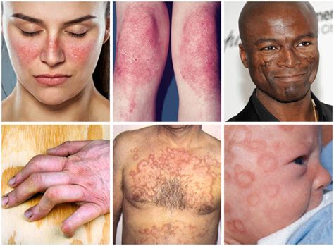 How bad is lupus