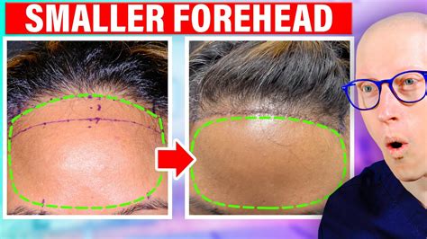 How big is too big for forehead? - thehealthyjournal.com