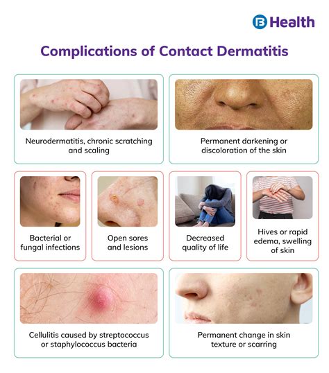 How common is contact dermatitis