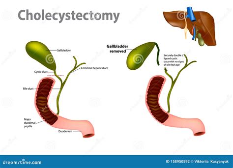 How common is gallbladder surgery