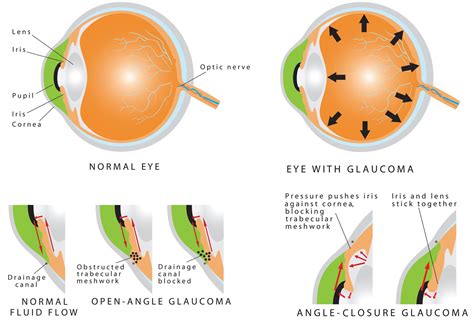 How common is glaucoma by age