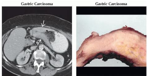 How common is linitis plastica
