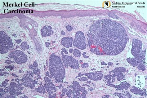 How common is merkel cell carcinoma