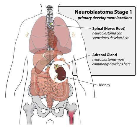 How common is neuroblastoma