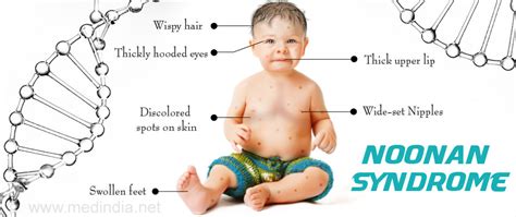 How common is noonan syndrome