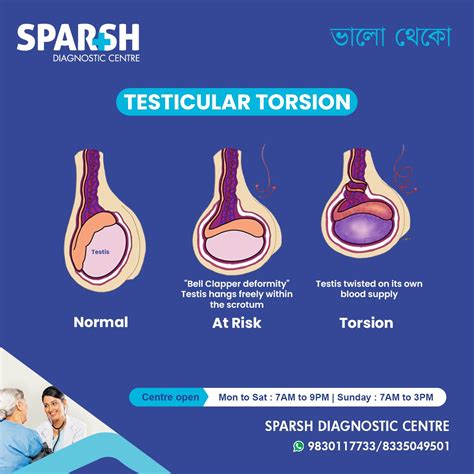 How common is testicular torsion