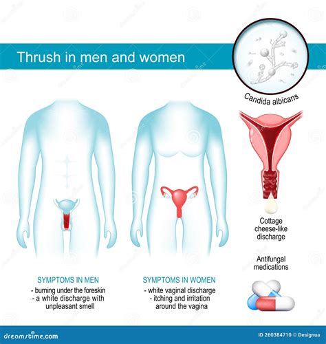 How common is thrush in men