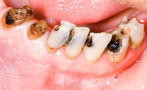 How common is tooth decay