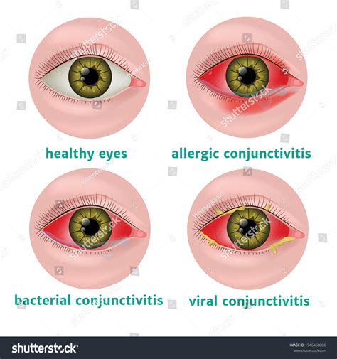 How contagious is bacterial conjunctivitis