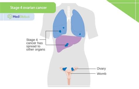 How curable is ovarian cancer