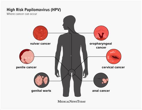 How dangerous is hpv