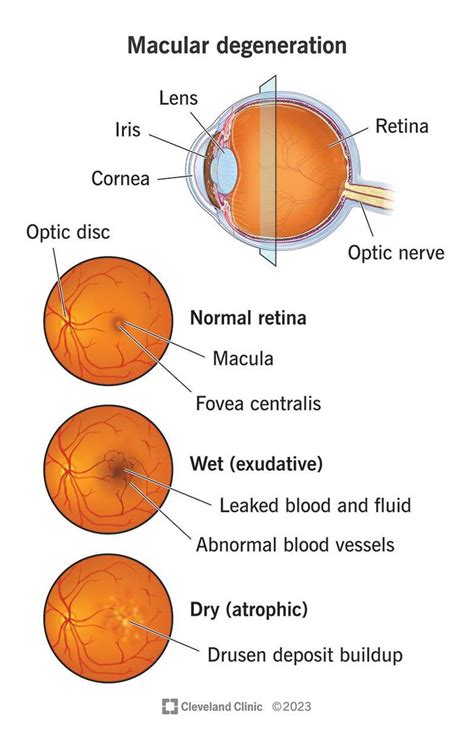 How diet may affect age-related macular degeneration