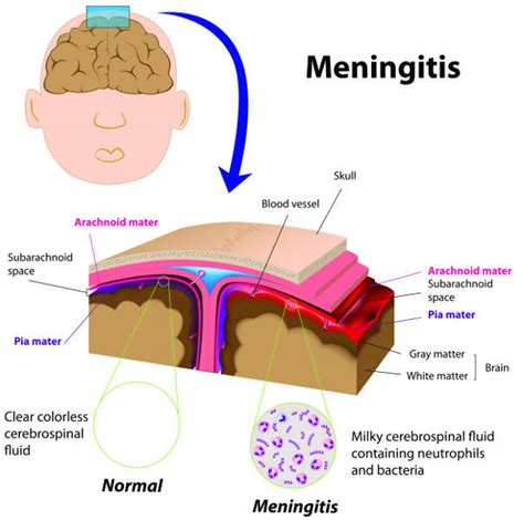 How do babies get meningitis. The MenB vaccine will protect your baby against infection by meningococcal group B bacteria. These bacteria are responsible for about 9 in every 10 meningococcal infections in young children. Meningococcal infections can be very serious, causing meningitis and sepsis. This can lead to severe brain damage, amputations and, sometimes, death. 