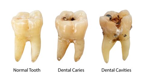 How do we make... teeth? - mtu Solutions