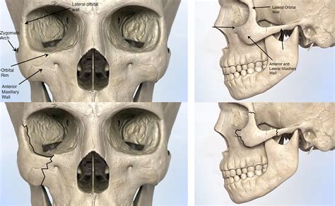 How do you know if you have broken your cheekbone – PPWikis