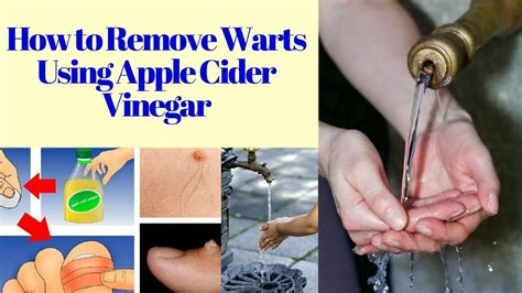 How to Remove Warts Naturally 1. Apple Cider Vinegar. How does it work? The acidic vinegar kills the skin of the wart, causing it to shed. What to do: Soak a small piece of cotton ball in apple cider vinegar. Press this against the wart and secure with a band aid. Repeat daily until the skin tag falls off.. 