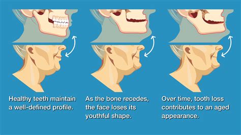 How do you reset your jaw bone? - Michele M