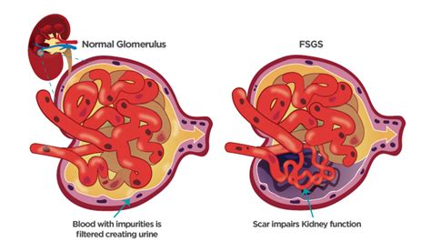 How does FSGS affect the kidneys Symptoms and treatment