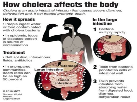 How does cholera affect the body? Bacterial Infections ...