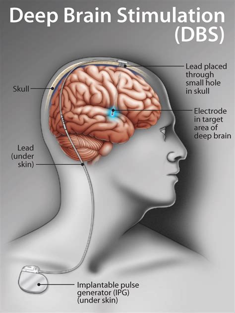 How does dbs work.  These areas Deep brain stimulation usually involves two procedures—ele...