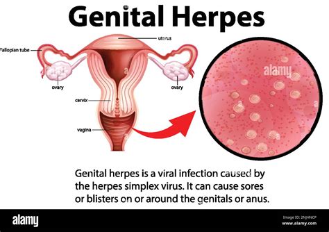 How easily is genital herpes spread