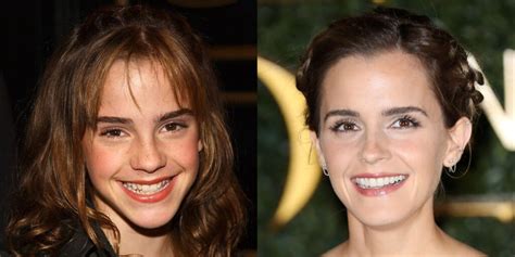 How fast do Celebrities mend their Teeth? Royal Dental Clinics Blog