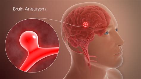 How fast do brain aneurysms grow