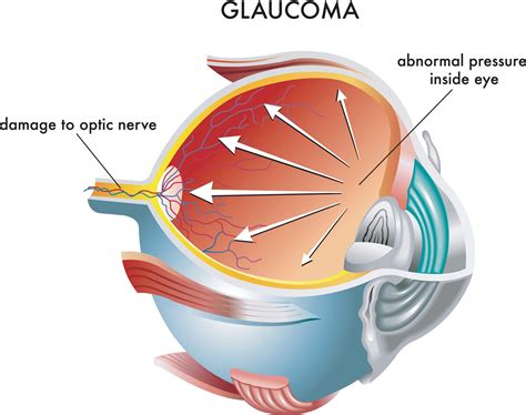 How fast does glaucoma progress