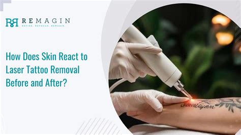 How good is laser tattoo removal
