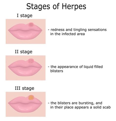 How herpes simplex is transmitted