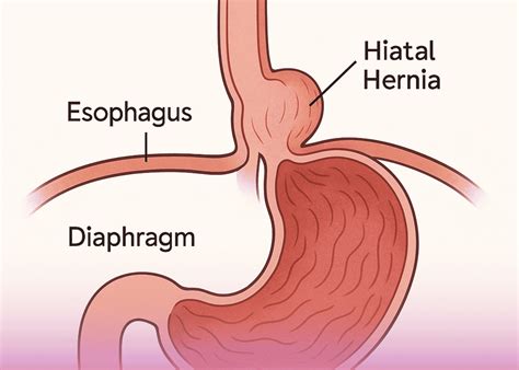 How hiatal hernia is treated