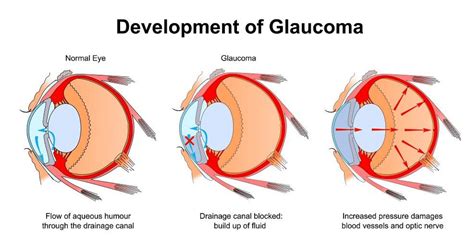 How i cured my glaucoma.  With the right combination of pressure-lowering treatm...