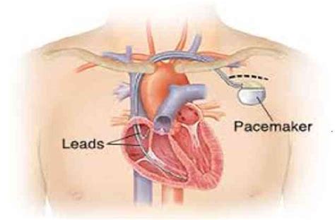 How invasive is pacemaker surgery