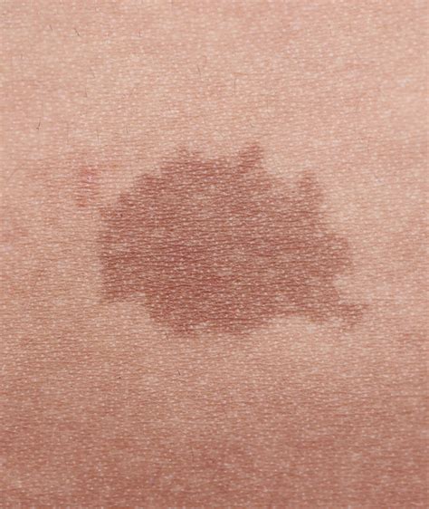 How is a birthmark made