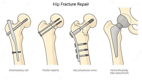 How is a broken hip treated