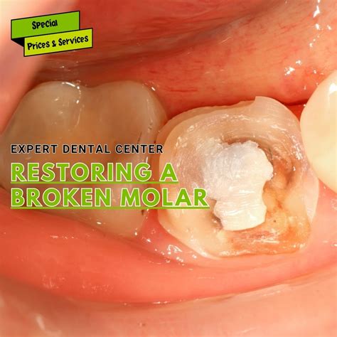 How is a broken molar fixed