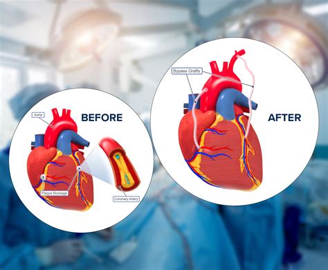 How is a cabg done