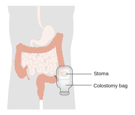 How is a colostomy bag attached