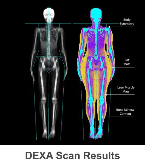 How is a dexa bone scan done