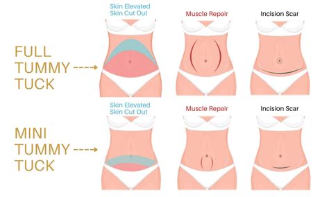 How is a mini tummy tuck done