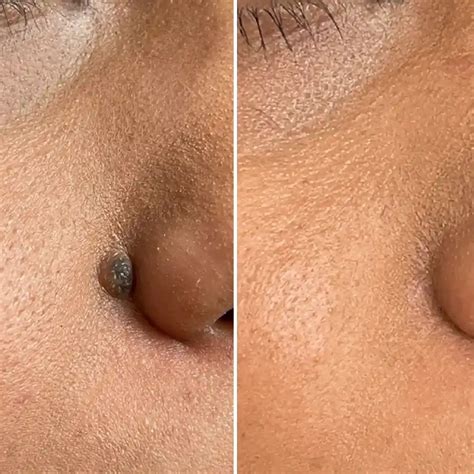 How is a mole biopsy done
