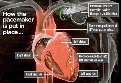 How is a pacemaker fitted