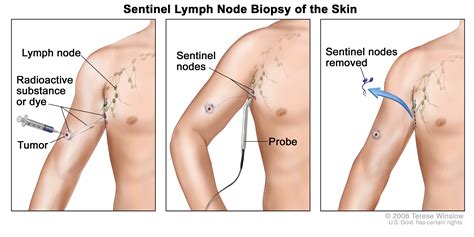 How is a sentinel node biopsy performed