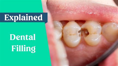 How is a tooth filling done