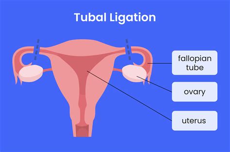 How is a tubal ligation performed