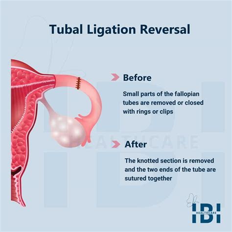 How is a tubal ligation reversal done