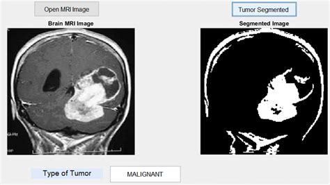 How is a tumor detected