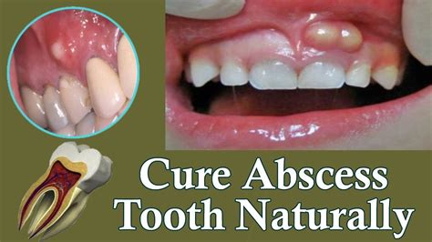 How is abscess tooth treated