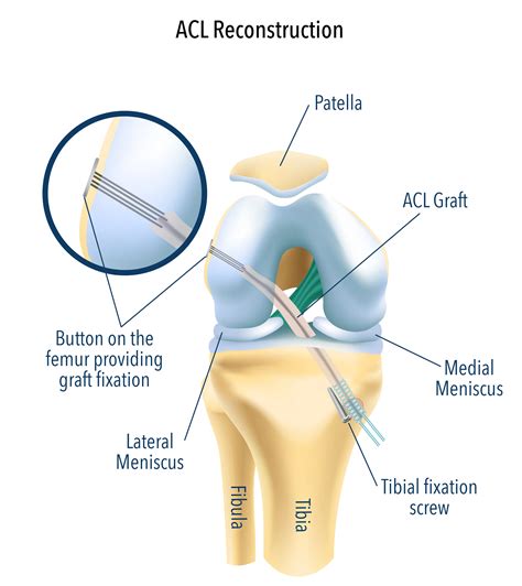 How is an acl repaired