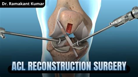How is an acl tear repaired